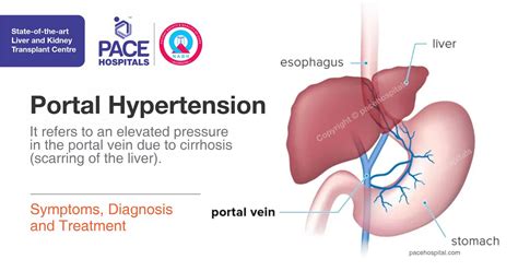 Portal Hypertension Symptoms Diagnosis And Treatment