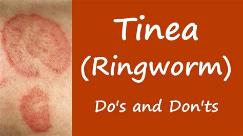 Ringworm In Humans