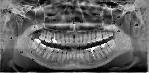 Panoramic Radiograph With Marked Anatomic Structures Download