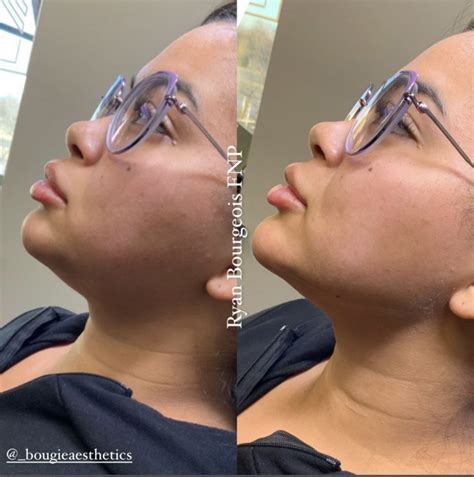 9 Ways To Use Dermal Fillers On The Face Bougie Aesthetics Bougie