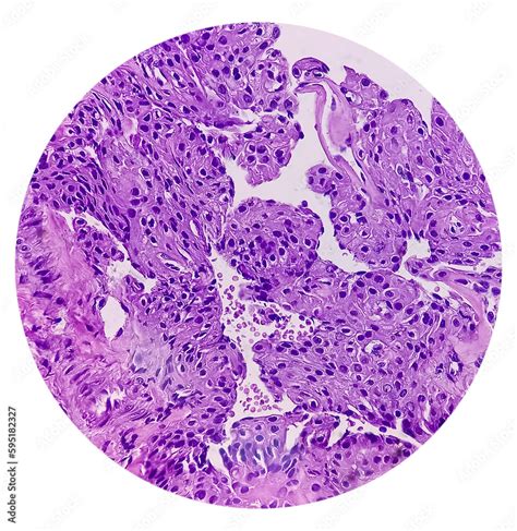 Nodular Cystic Hidradenoma Clear Cell Hidradenoma Nodular Hidradenoma