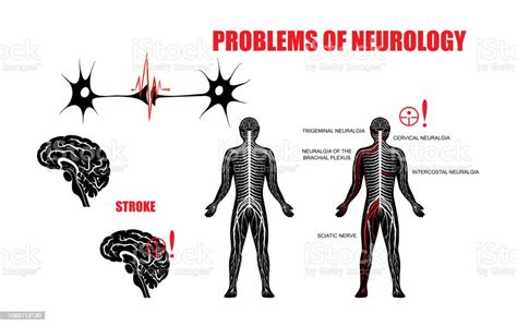 Nervous System And Neurological Diseases Stock Illustration Download