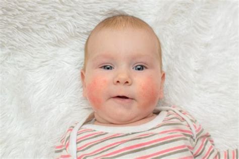 Allergies In Children Kars4kids Smarter Parenting