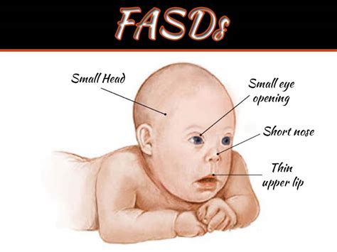What Is Fetal Alcohol Spectrum Disorders Fasds 99 Health Ideas