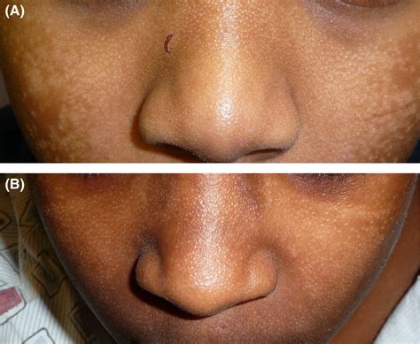 Facial Hypopigmentation In Skin Of Color An Atypical Presentation Of