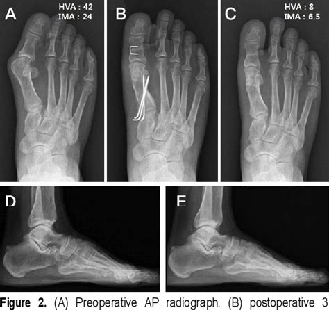 Figure 1 From Treatment Of Severe Hallux Valgus Deformity With Proximal