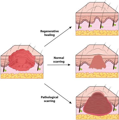 Stages Of Tissue Repair