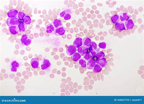 Acute Promyelocytic Leukemia Cells Or Apl Stock Photo Image Of