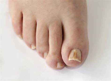 What Does Toenail Fungus Look Like In The Early Stages All Questions