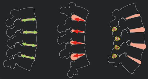 Biomechanics Of The Spine Posture Forces And Structures Core Advantage
