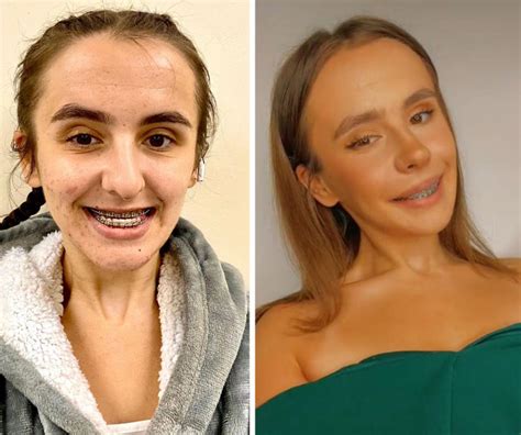 Tiktok Star Looks Like Cartoon Character As Top Jaw Is Mm Too Small Until Successful Surgery