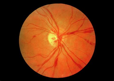 Old Retinal Vasculitis