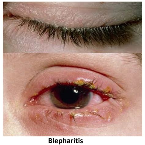 Swollen Eyelid Know The Causes Remedies And Alert Signs