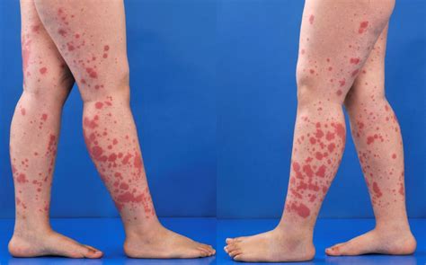 Púrpura Henoch-schönlein é Grave