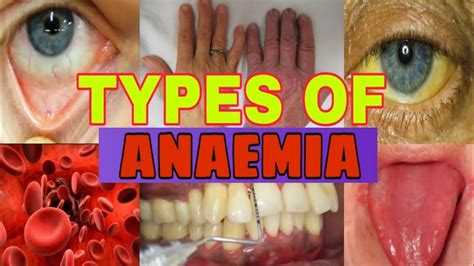 Types Of Anemia Anemia Classification Aplastic Anaemia Anemia