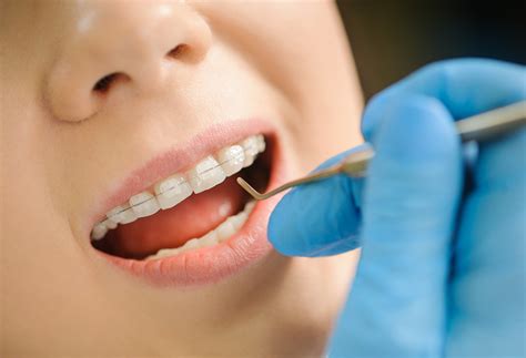 Everything You Need To Know About Ceramic Braces Smile Up Dental