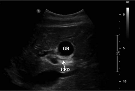 Acute Acalculous Cholecystitis Of An Intrahepatic Gallbladder Causing