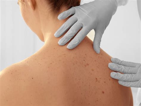 Facts To Know About Skin Cancer Best Health Magazine Canada