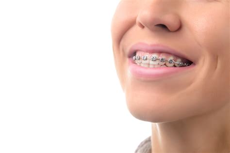 How Long Do You Have To Wear Braces For Crowded Teeth Fix Crowded