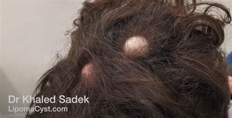 Scalp Lump Cyst And Lipoma Specialists