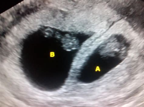 Twin Ultrasound 8 Weeks