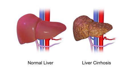 Liver Cirrhosis Causes Symptoms And Ayurvedic Treatment