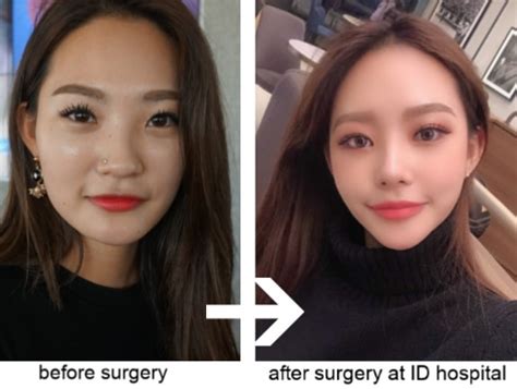 India Snapchat Dysmorphia Plastic Surgery What Is It Menafncom