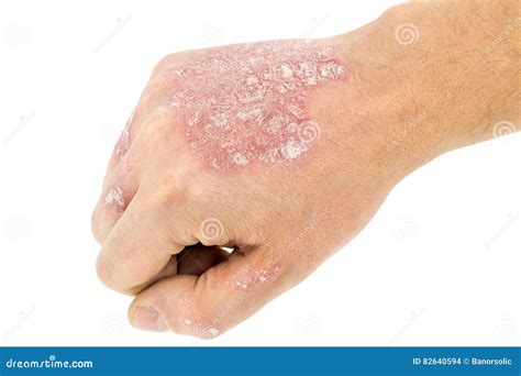 Psoriasis On The Hand Isolated On White Stock Photo Image Of