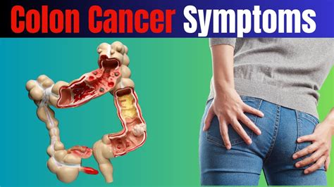 Colon Cancer Symptoms Colon Cancer 7 Warning Signs Of Colon Cancer
