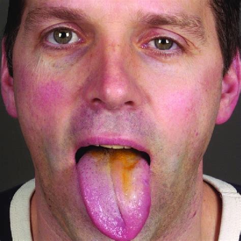 Tongue Deviation Due To Paresis Caused By Hypoglossal Nerve Injury