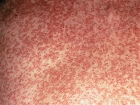 Sydney Measles Warning After Infected Duo Return To Nsw