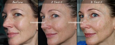 Retin A For Wrinkles 3 Year Results Before And After