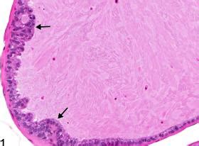 Coagulating Gland Hyperplasia Nonneoplastic Lesion Atlas