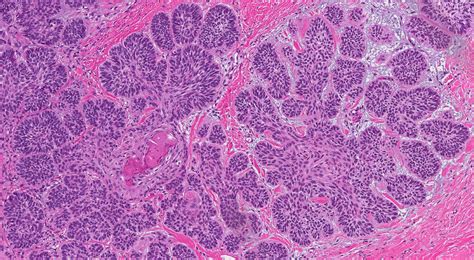 Basal Cell Carcinoma Of The Skin MyPathologyReport Ca