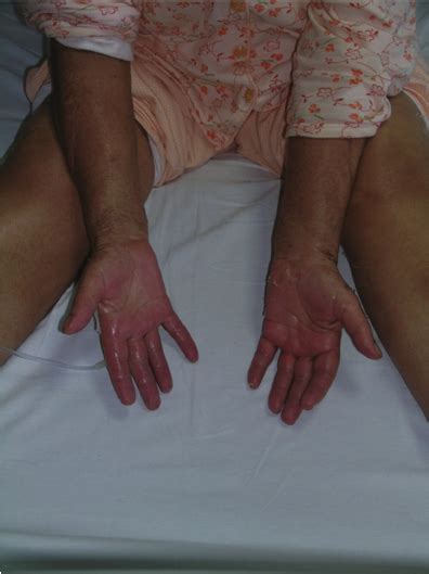 Exfoliative Dermatitis Hands