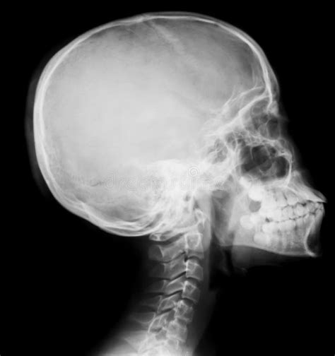 Detail Of Neck And Head X Ray Image Stock Image Image Of Area Inside