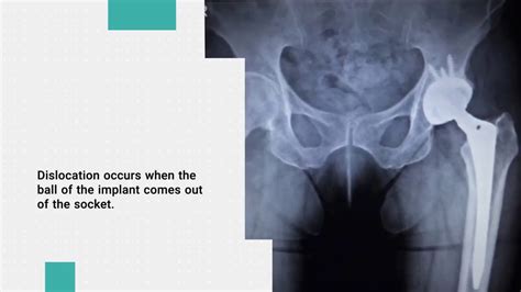 What Should I Know About Dislocation After Hip Replacement Youtube