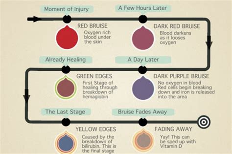 Stages Of A Bruise Coolguides