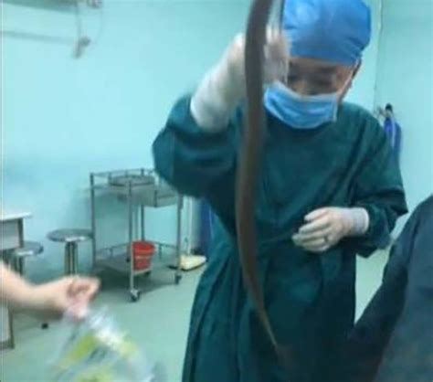 man gets eel stuck up his anus but won t tell doctors how it got there metro news