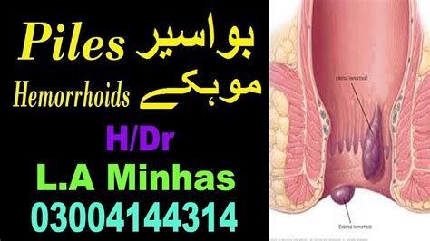 piles hemorrhoids causes symptoms treatment h dr minhas بواسیر موہکےوجوہات علامات علاج youtube
