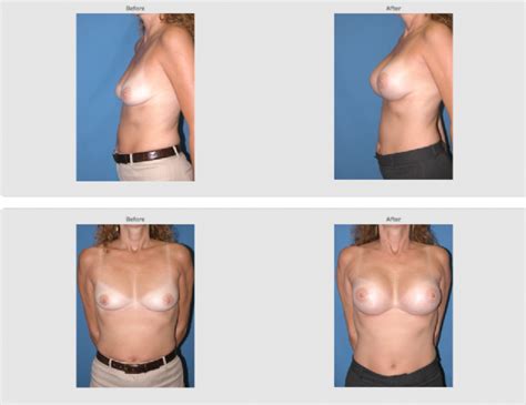 Breast Augmentation Holzapfel Lied Plastic Surgery