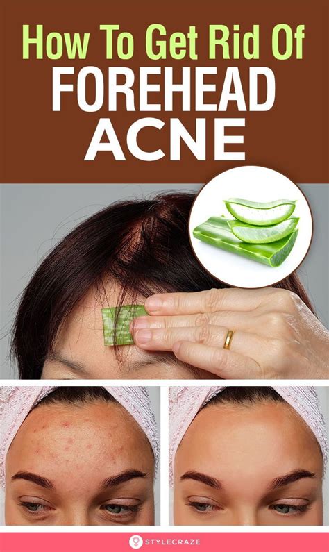 How To Get Rid Of Spots On Forehead Juice