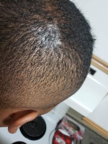 Itchy Flaking White Spots On Scalp Dermatology Forums Patient