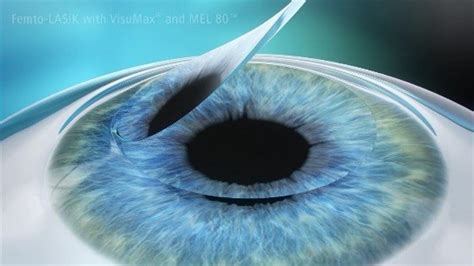 Which insurance plans cover some or all of the cost of lasik? Laser Eye Surgery Cost Hong Kong | Lasik Price- SMILE