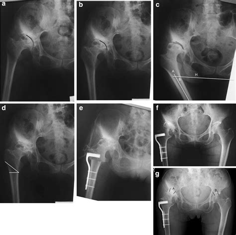 Preoperative Hip Radiographs Abduction A Neutral B And Adduction