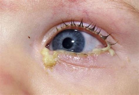 Pink Eye Conjunctivitis Symptoms And Treatment Things Health