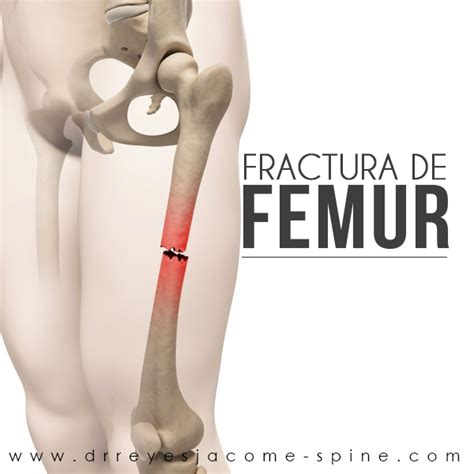 FRACTURA DE FEMUR Cirugia De Columna En Matamoros