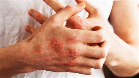 Generalized Pustular Psoriasis The Awareness Campaign Starts