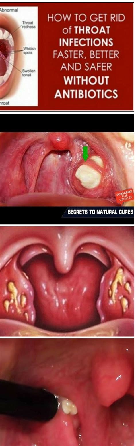 Get Rid Of Tonsillitis And Sore Throat Naturally Natural Cures The