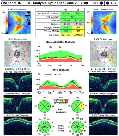 Normal Rnfl Thickness In Optical Coherence Tomography Onh Optic